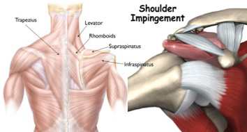 Rotator cuff impingement